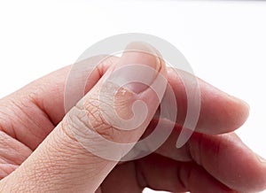 A close-up of a hangnail on a white background photo