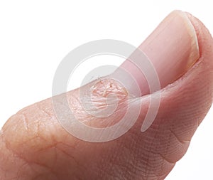 A close-up of a hangnail on a white background photo