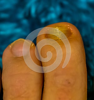 Close up of healthy and a fungus infected toe nail, Common nail infection and disease