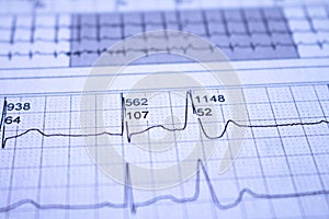 Close-up of heartbeat recorded on paper. Electrocardiogram with cardiac arrhythmia. Ventricular extrasystoles recorded