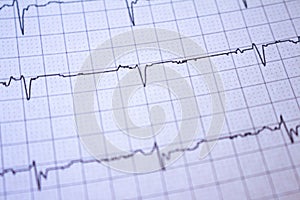 Close-up of heartbeats recorded on the paper of the electrocardiogram. Selective focus. Approach to a cardiac arrhythmia