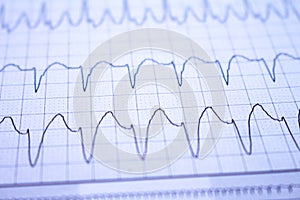 Close-up of heartbeats recorded on the paper of the electrocardiogram. Selective focus. Approach to a cardiac arrhythmia