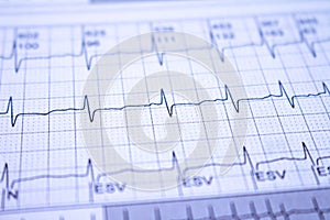 Close-up of heartbeats recorded on the paper of the electrocardiogram. Selective focus. Approach to a cardiac arrhythmia