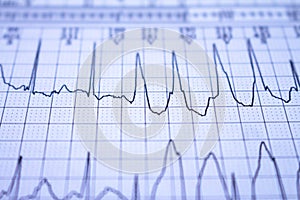 Close-up of heartbeats recorded on the paper of the electrocardiogram. Selective focus. Approach to a cardiac arrhythmia