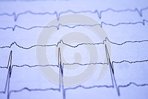 Close-up of heartbeats recorded on the paper of the electrocardiogram. Selective focus. Approach to a cardiac arrhythmia