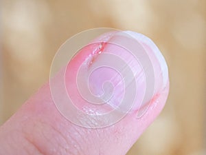 A close-up of a human finger showing a healing cut