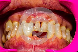 Close up human patient open mouth showing caries teeth decay with gingivitis