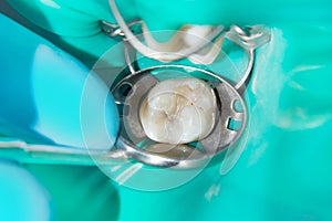 Close-up of a human rotten carious tooth at the treatment stage