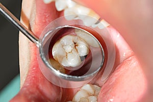 Close-up of a human rotten carious tooth at the treatment stage