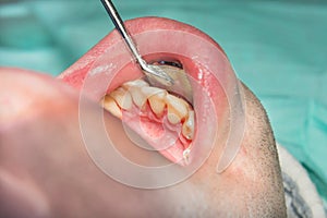 Close-up of a human rotten carious tooth at the treatment stage