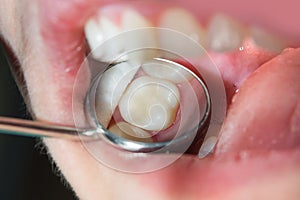 Close-up of a human rotten carious tooth at the treatment stage