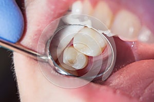 Close-up of a human rotten carious tooth at the treatment stage