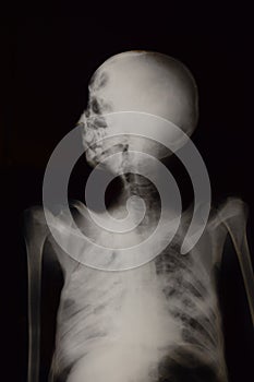 Human upper body roentgenogram photo