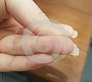 Close up image of a cut on a girl`s finger with blur