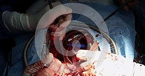 Close up of implantation of a biological heart valve cardiovascular surgery open heart surgery