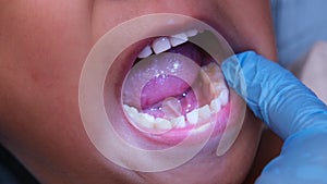 Close-up inside the oral cavity of a healthy child with beautiful rows of baby teeth.