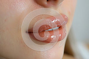 Close up of large lips of woman with Hyaluronic acid beauty fillers