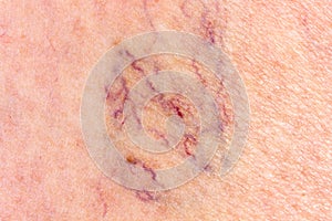 Close-up of leg with varicose veins