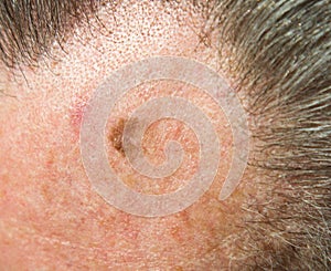 Caused by sun damage by prolonged exposure since youth a lentigo maligna, melanoma in situ on the forehead of a 64 year old man photo