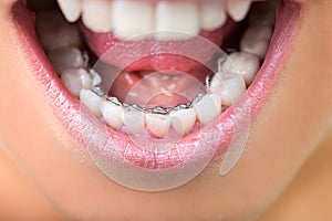 Close up of lingual braces