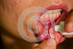 Close - up on the lip with aphthous stomatitis applying antibacterial cream