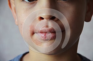 close up lips and face of a schoolboy or teenager with allergies. Lip irritation. Portrait of smiling child sneezing