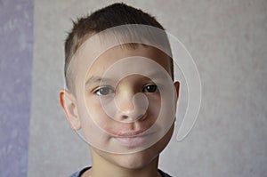 close up lips and face of a schoolboy or teenager with allergies. Lip irritation. Portrait of smiling child sneezing