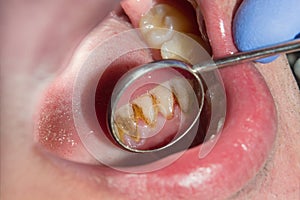 Close-up of macro dental calculus and dental plaque. Oral hygiene in dentistry