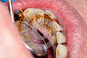 Close-up of macro dental calculus and dental plaque. Oral hygiene in dentistry photo