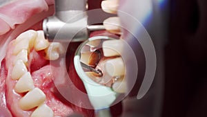 Close-up macro shot of preparing woman's teeth for installing zirconia veneers. Dentist using mirror, removing tooth