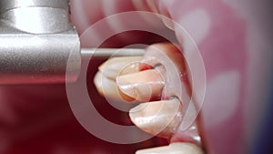 Close-up macro shot of removing tooth enamel by dental bur before installing zirconia veneers. Dentist preparing