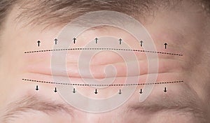 Close-up of male forehead with wrinkles and markers for surgery. Forehead plastic surgery concept, forehead wrinkle lift,