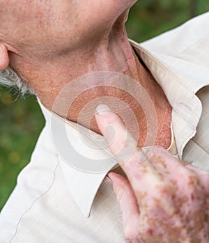 Close up of male hand and neck with vitiligo pigments