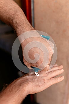 Close up of male hands applying treatment for skin condition. Medicine for treating Vitiligo