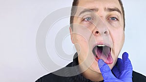 Close-up of a man black tongue. Clinical manifestations of lingua villosa. Bacterial infection of the mouth. The consequences of