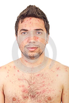 Close up man with chickenpox