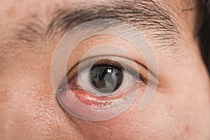 Close up of man eye stye