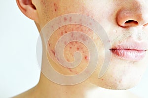 Close up of man with problematic skin and scars from acne.