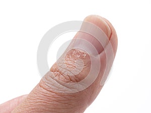 A close-up of a hangnail on a white background photo