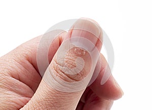 A close-up of a hangnail on a white background photo