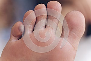 Close-up of man`s foot finger with a large blister