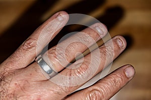 close-up of a man& x27;s hand with obsessive compulsive onychophagy disorder