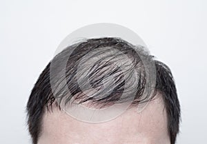 Close up man`s head with hair loss, thinning hair or alopecia isolated on white background. Hair problem