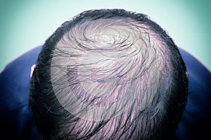 Close up man`s head with hair loss, thinning hair or alopecia isolated on white background. Hair problem