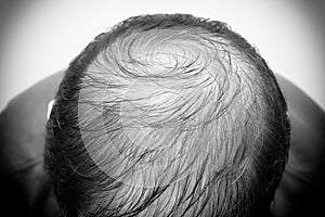 Close up man`s head with hair loss, thinning hair or alopecia isolated on white background. Hair problem