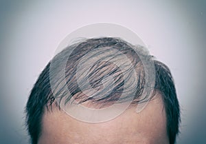 Close up man`s head with hair loss, thinning hair or alopecia isolated on white background with old analog film effect. Hair