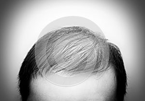 Close up man`s head with hair loss, thinning hair or alopecia  on white background. Hair problem