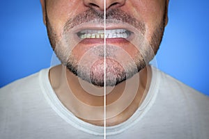 Close-up of a man\'s mouth, before and after teeth care