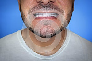 Close-up of a man\'s mouth, after teeth care