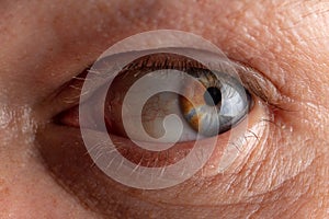 Close-up of a manâ€™s eye with a birthmark on the pupil